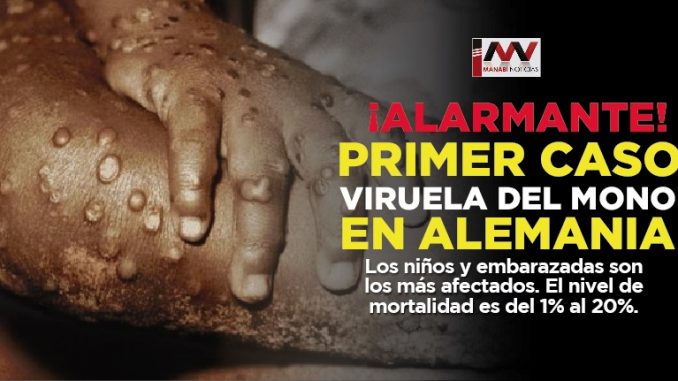 viruela del mono